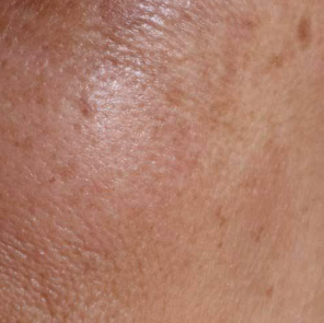 skin pigmentation