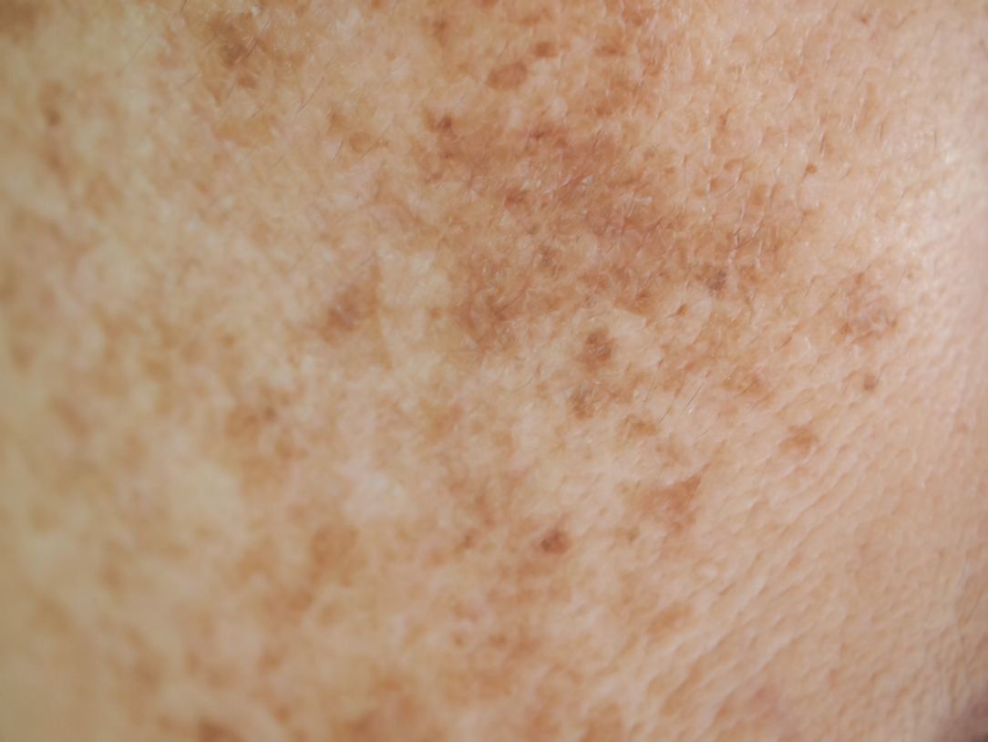 stubborn pigmentation