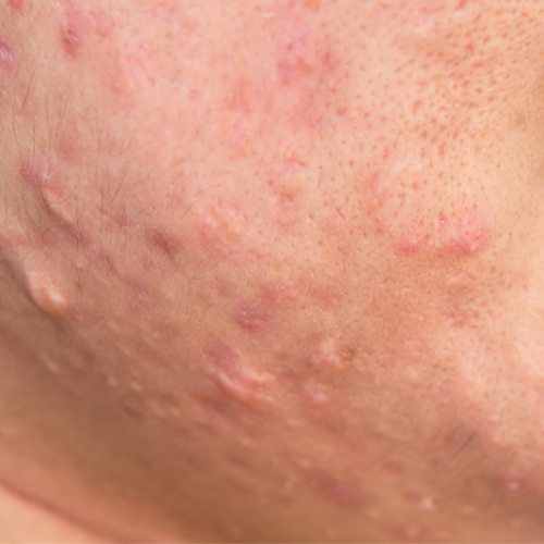 hypertrophic acne scar