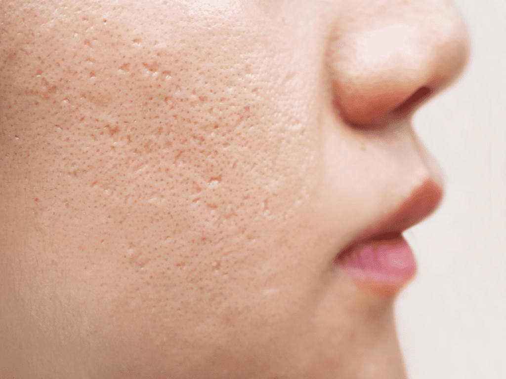 laser resurfacing for acne skin resurfacing