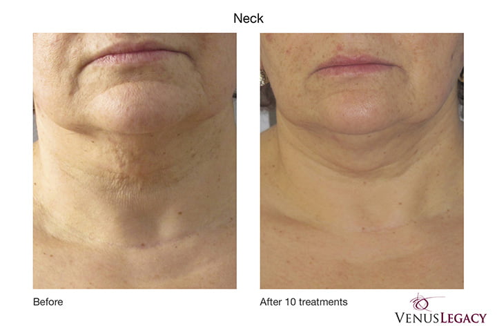 venus legacy neck before after