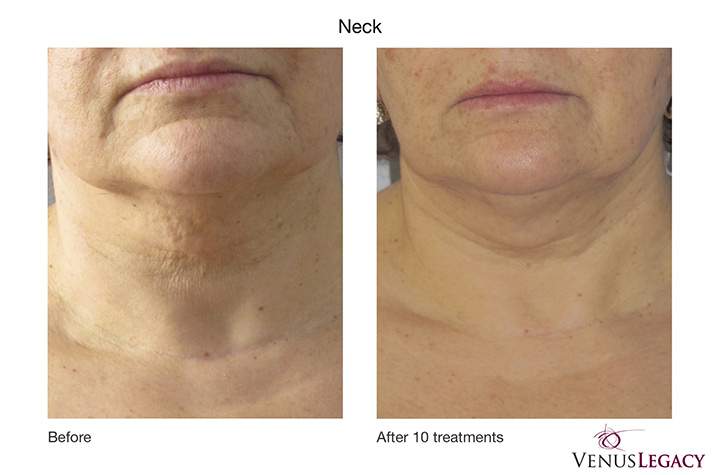 venus legacy neck before after